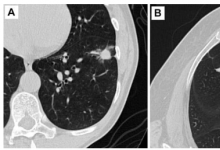 肺癌筛查显着提高长期生存率