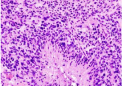哪些胶质母细胞瘤患者会对免疫疗法产生反应