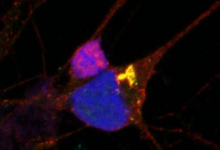 研究发现神经系统星形细胞在散发性运动神经元病中的初始保护作用