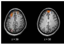 多中心神经影像学研究为精神分裂症提供新见解