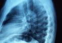 研究发现乳房 MRI 可有效检测致密乳房中的癌症