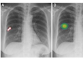AI 改善胸部 X 线检查中的肺结节检测