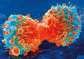 研究揭示了为什么一些前列腺癌更具侵袭性