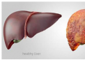 通用肠道微生物组衍生特征可预测肝硬化