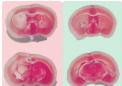 新药减少小鼠中风损伤