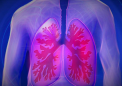 一种检测肺癌预后不良高风险患者的工具
