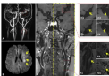 MRI 研究揭示了动脉罪魁祸首斑块的特征