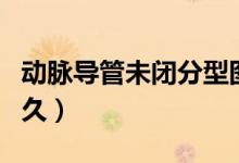 动脉导管未闭分型图片（动脉导管未闭能活多久）