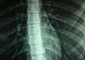 AI 准确检测中轴型脊柱关节炎中的放射学骶髂关节炎