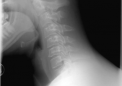 为什么在复杂的脊柱手术前改善骨骼健康很重要
