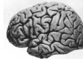 描述了亨廷顿病的脑斑块结构