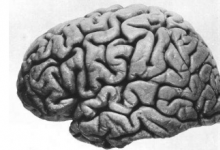 描述了亨廷顿病的脑斑块结构
