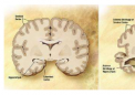 遗传性阿尔茨海默病中脂质关联的证据