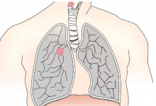 一种蛋白质是肺癌扩散的关键：新研究找到了阻止它的方法