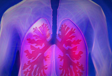 物理治疗被证明可以显着改善慢性阻塞性肺病患者的生活质量