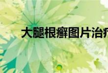 大腿根癣图片治疗(大腿根部藓图片)
