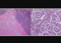 甲状腺癌的基因改变介导对 BRAF 抑制和间变性转化的抵抗