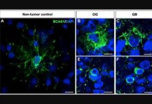 BCAS1定义了弥漫性神经胶质瘤患者的异质细胞群