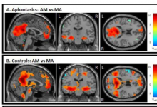 研究人员发现自传体记忆与失语症之间的联系